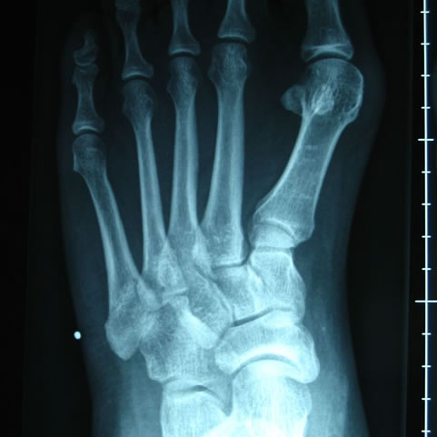 Foot x-ray